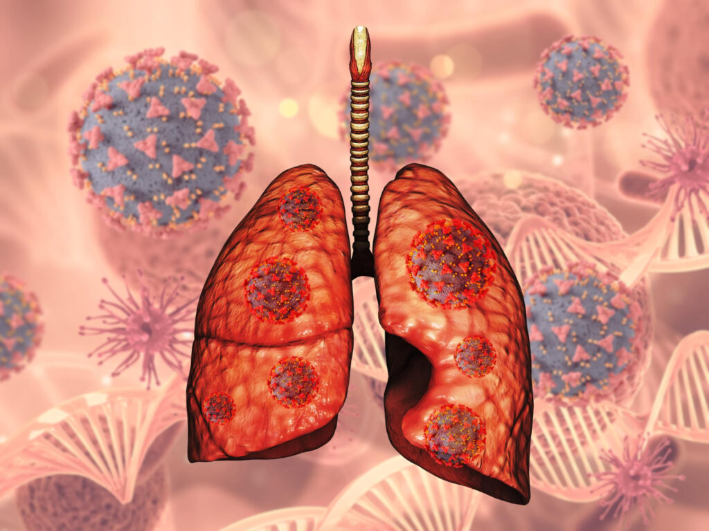 Stage 3 Lung Cancer